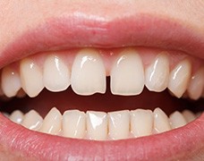 Teeth with gap