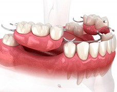 Illustration of partial denture