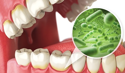 a digital illustration showing bacteria along the gumline of a mouth