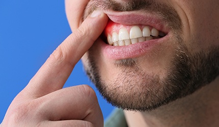 a man holding up his lip to reveal red gums