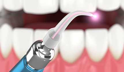 Soft tissue laser used for laser gum treatment