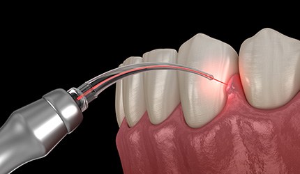 Illustration of laser being used to treat gums