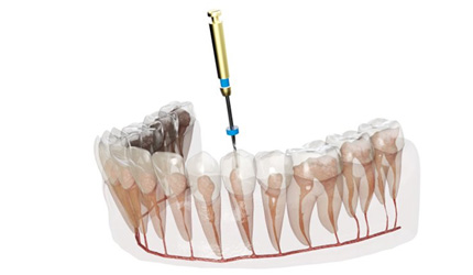 A digital image of a root canal in DeSoto